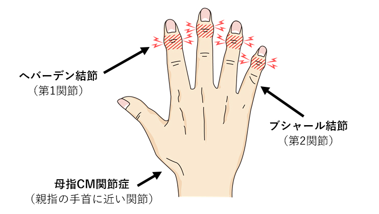 画像：図1 手指変形性関節症が起こりやすい部位