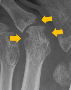画像:レントゲン検査で確認される小さな骨びらん