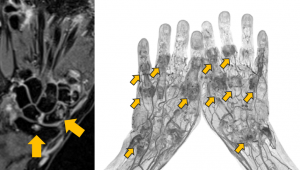画像:MRI画像で確認される骨髄浮腫（左）と多発している関節の炎症（右）