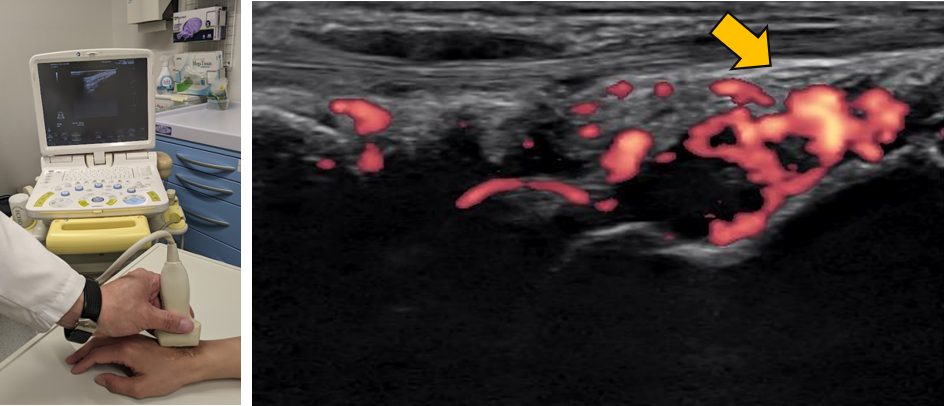 画像:エコー検査で確認できる滑膜炎の血流