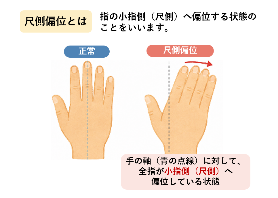 画像:尺側偏位