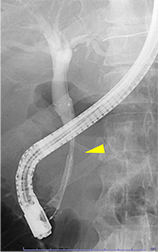 胆管ステント留置後