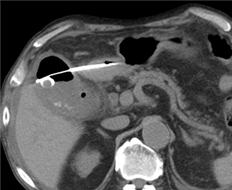 十二指腸から胆嚢にステント留置