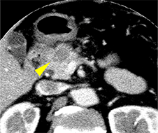 CTで膵頭部腫瘤を指摘