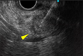 EUS-FNAで組織採取