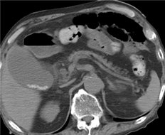 急性胆嚢炎で受診
