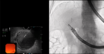 超音波内視鏡下胆嚢ドレナージ