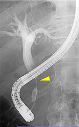 膵癌による胆管狭窄