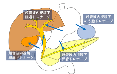 胆嚢ドレナージのイラスト
