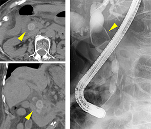 巨大な総胆管結石