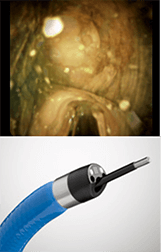 経口胆道鏡を用いて衝撃波で破砕