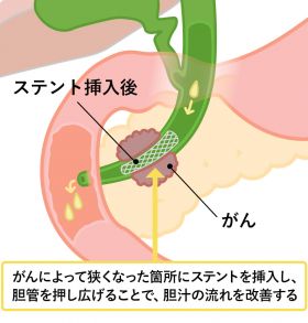 イラスト:胆管ステント
