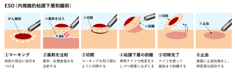 画像:ESD