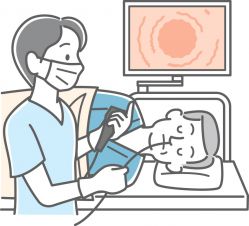 イラスト:内視鏡検査